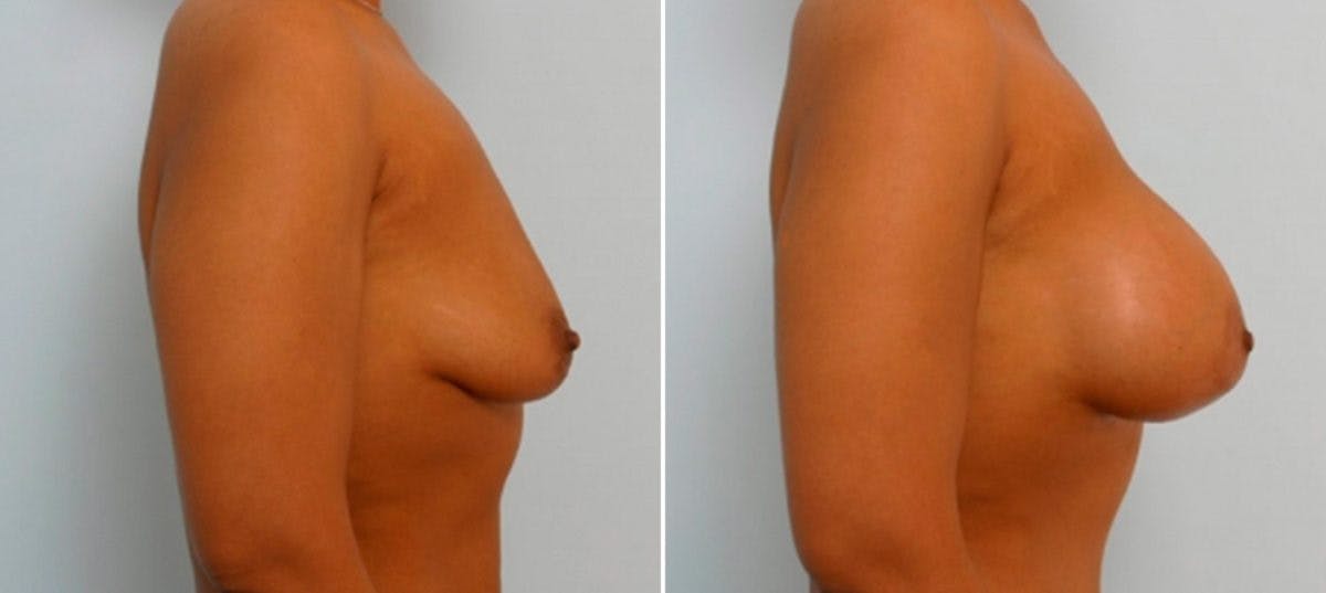 Breast Augmentation Before & After Gallery - Patient 54886808 - Image 3