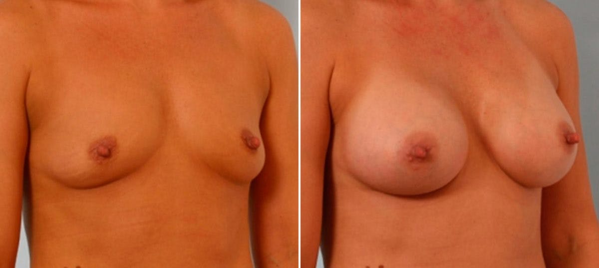 Breast Augmentation Before & After Gallery - Patient 54886810 - Image 2
