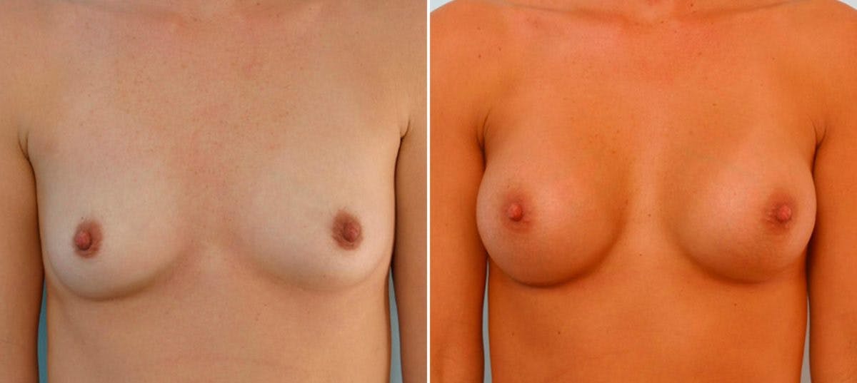 Breast Augmentation Before & After Gallery - Patient 54886813 - Image 1