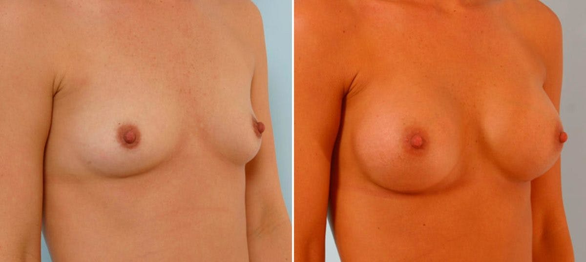 Breast Augmentation Before & After Gallery - Patient 54886813 - Image 2