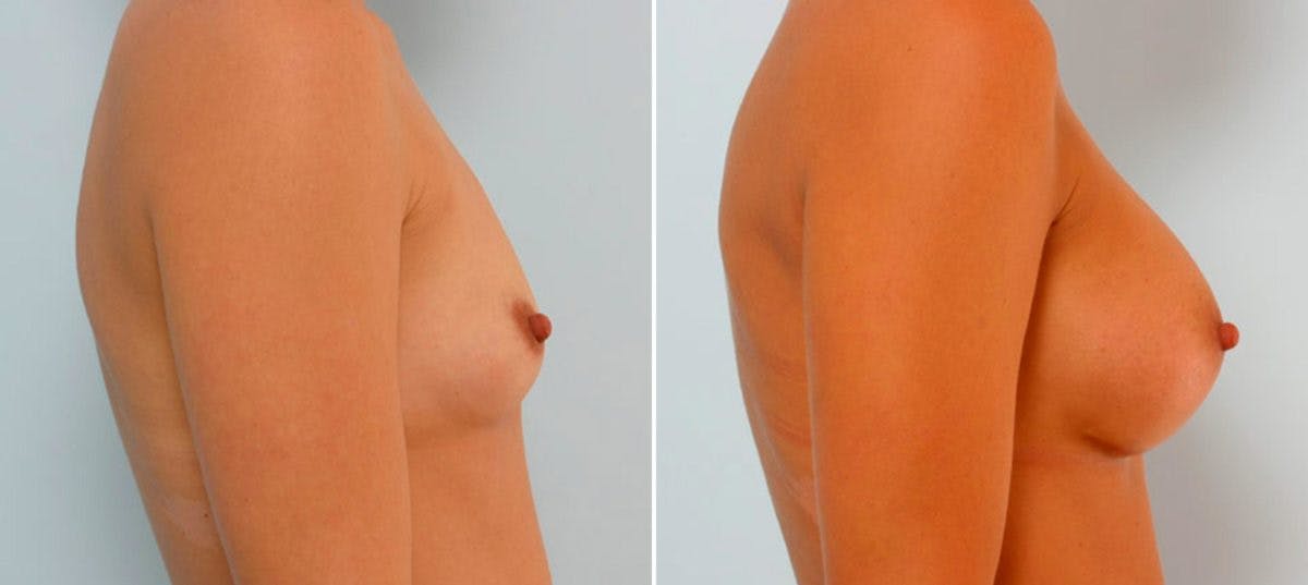 Breast Augmentation Before & After Gallery - Patient 54886813 - Image 3