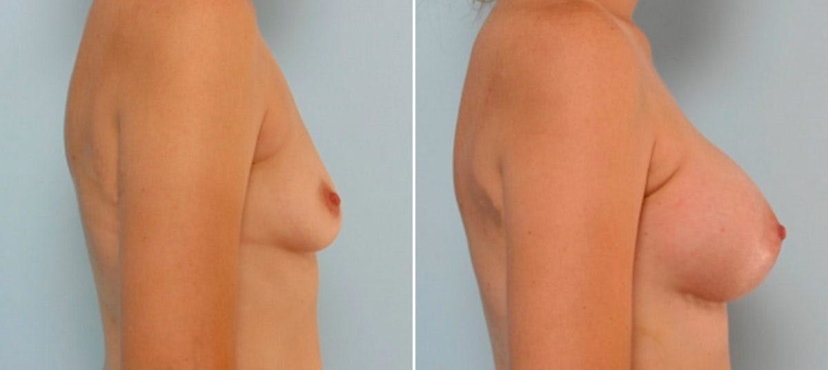 Breast Augmentation Before & After Gallery - Patient 54886817 - Image 3