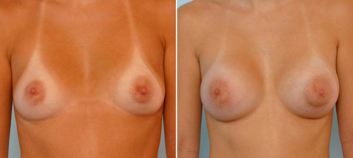 Breast Augmentation Before & After Gallery - Patient 54886819 - Image 1