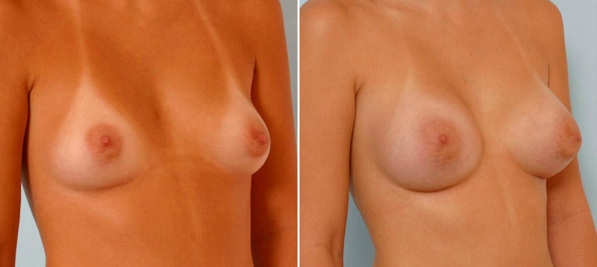 Breast Augmentation Before & After Gallery - Patient 54886819 - Image 2