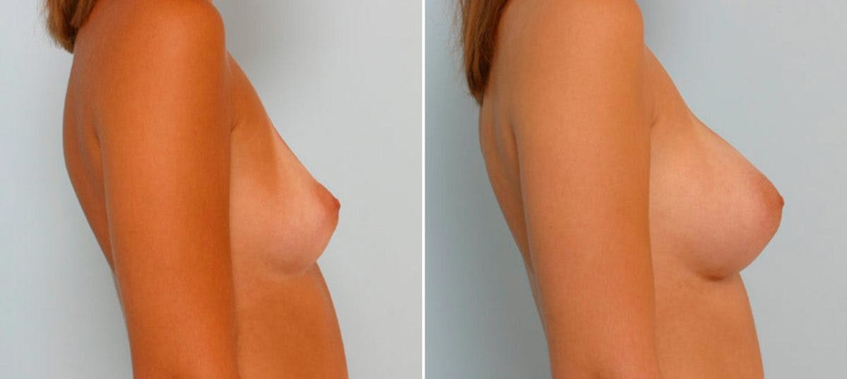Breast Augmentation Before & After Gallery - Patient 54886819 - Image 3