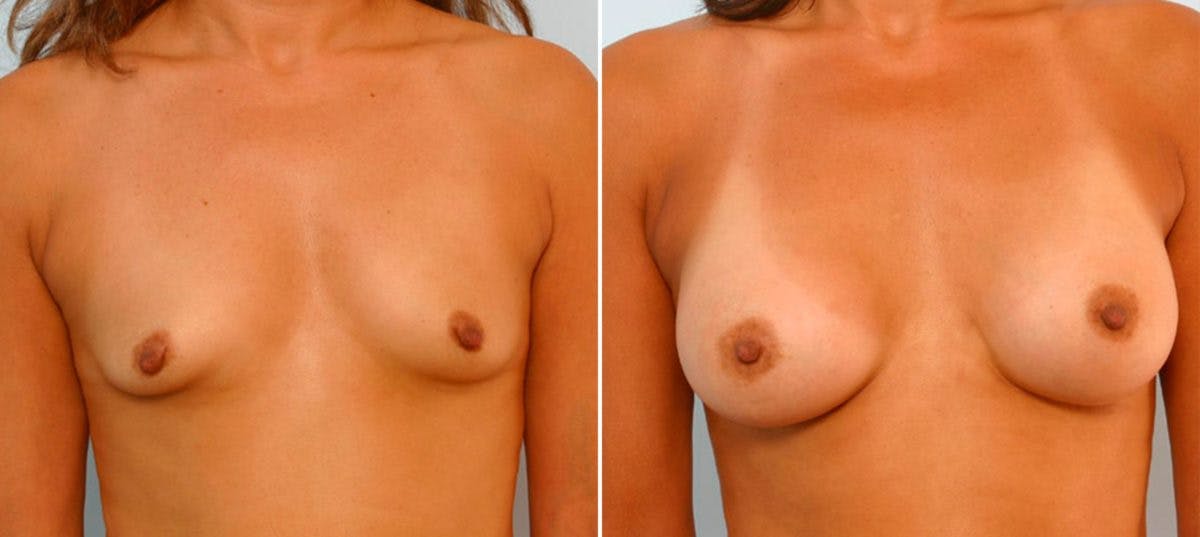 Breast Augmentation Before & After Gallery - Patient 54886822 - Image 1