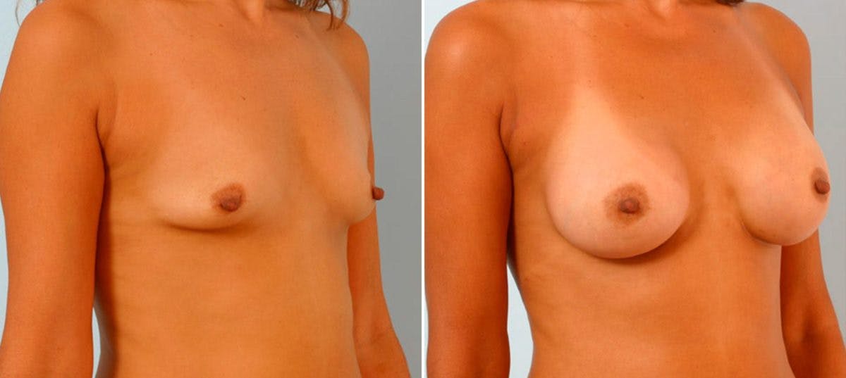 Breast Augmentation Before & After Gallery - Patient 54886822 - Image 2