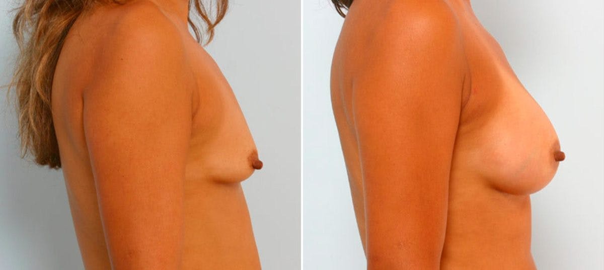 Breast Augmentation Before & After Gallery - Patient 54886822 - Image 3