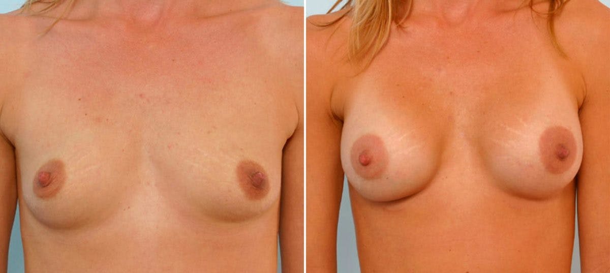 Breast Augmentation Before & After Gallery - Patient 54886823 - Image 1