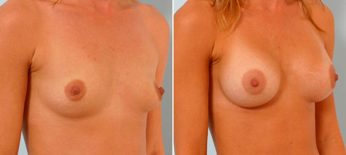 Breast Augmentation Before & After Gallery - Patient 54886823 - Image 2