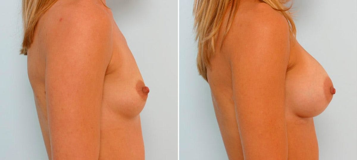 Breast Augmentation Before & After Gallery - Patient 54886823 - Image 3