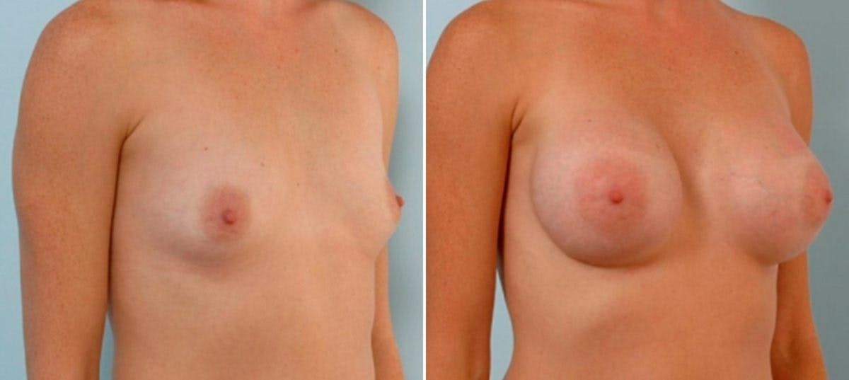 Breast Augmentation Before & After Photo - Patient 54886824 - Image 2
