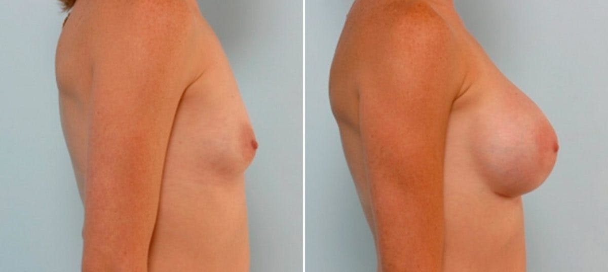 Breast Augmentation Before & After Gallery - Patient 54886824 - Image 3