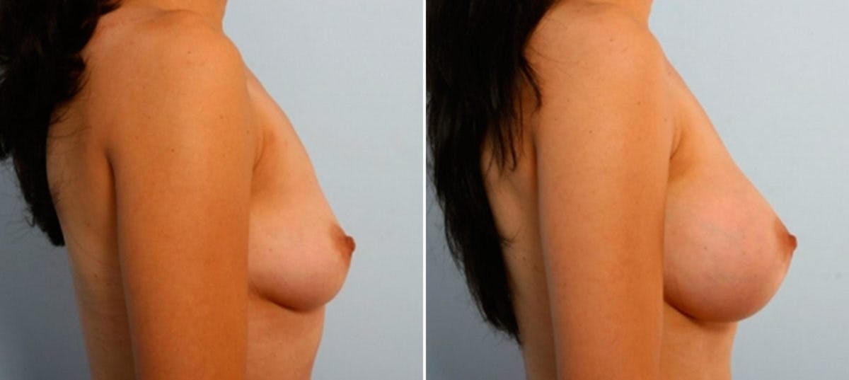Breast Augmentation Before & After Gallery - Patient 54886825 - Image 3
