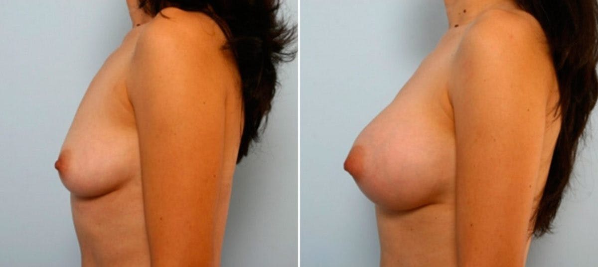 Breast Augmentation Before & After Gallery - Patient 54886825 - Image 5