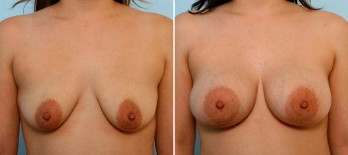 Breast Augmentation Before & After Gallery - Patient 54886829 - Image 1