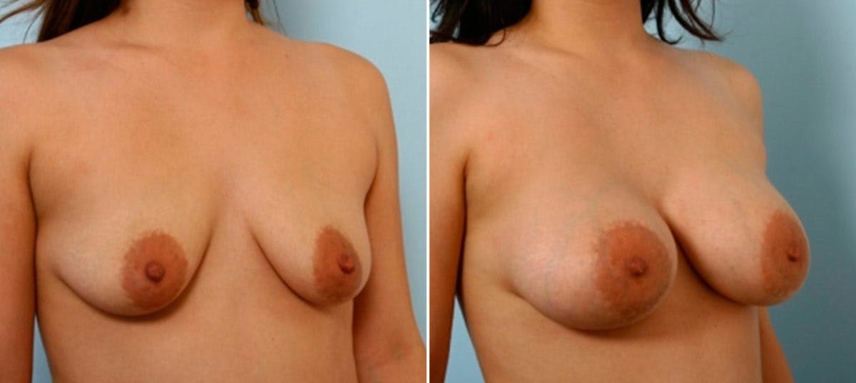 Breast Augmentation Before & After Gallery - Patient 54886829 - Image 2