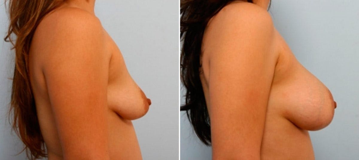 Breast Augmentation Before & After Gallery - Patient 54886829 - Image 3