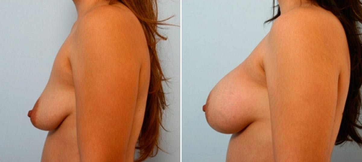 Breast Augmentation Before & After Gallery - Patient 54886829 - Image 5