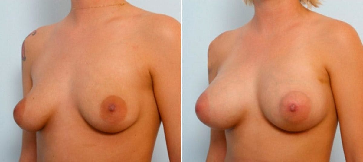 Breast Augmentation Before & After Gallery - Patient 54886830 - Image 2