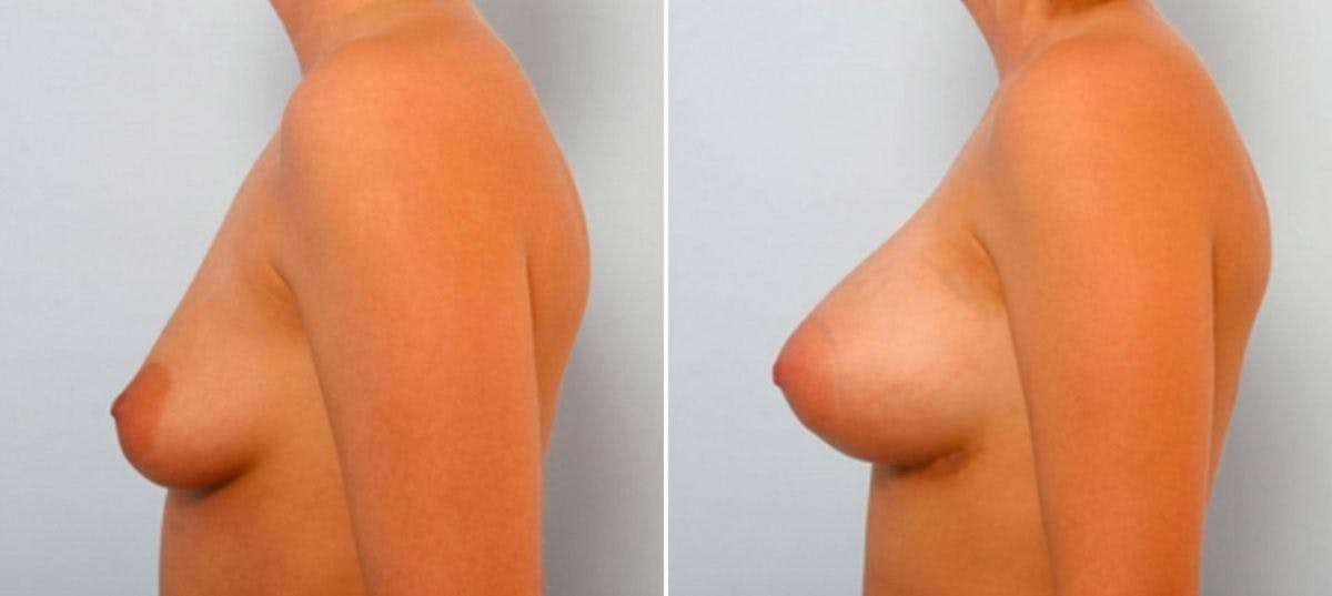 Breast Augmentation Before & After Gallery - Patient 54886830 - Image 3