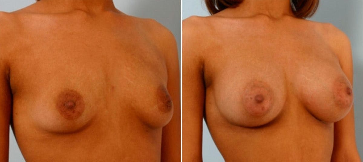 Breast Augmentation Before & After Gallery - Patient 54886833 - Image 2