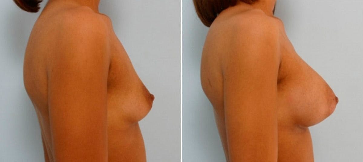 Breast Augmentation Before & After Gallery - Patient 54886833 - Image 3