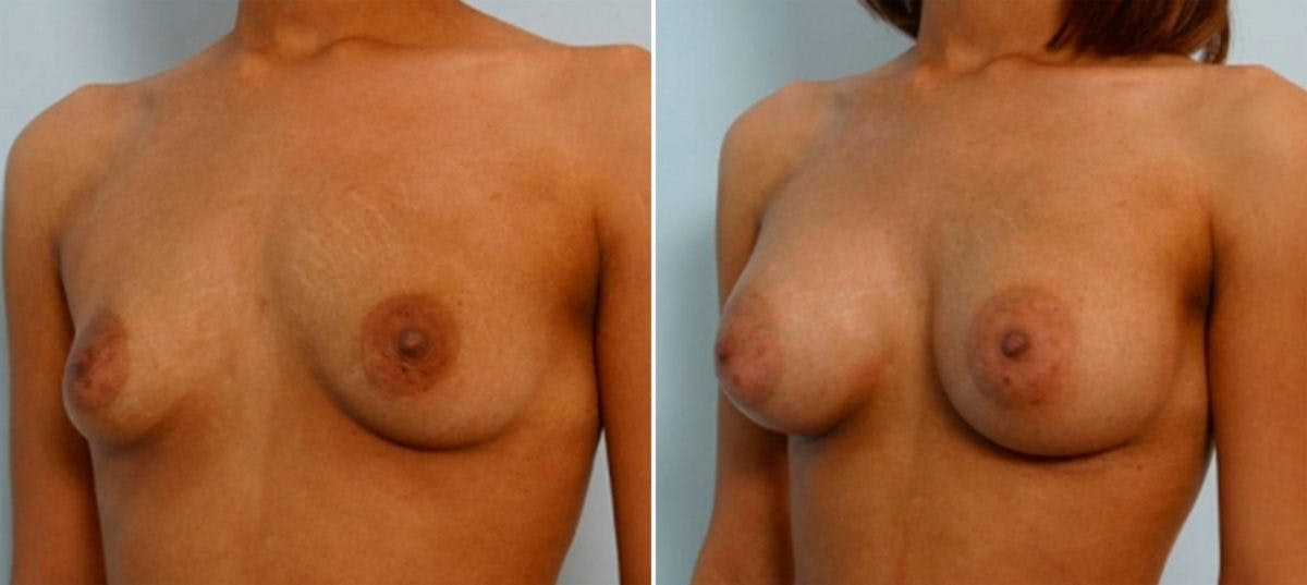 Breast Augmentation Before & After Gallery - Patient 54886833 - Image 4