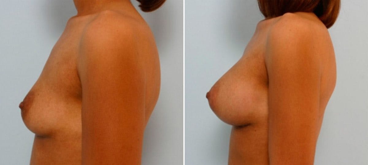 Breast Augmentation Before & After Gallery - Patient 54886833 - Image 5