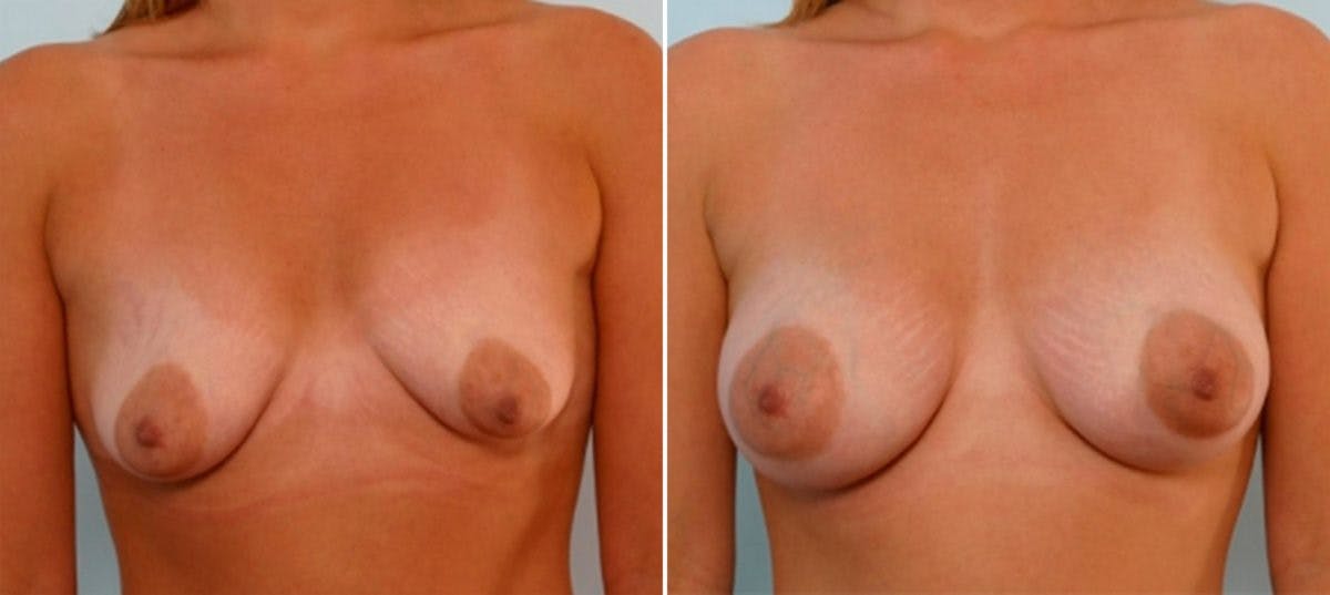Breast Augmentation Before & After Gallery - Patient 54886834 - Image 1