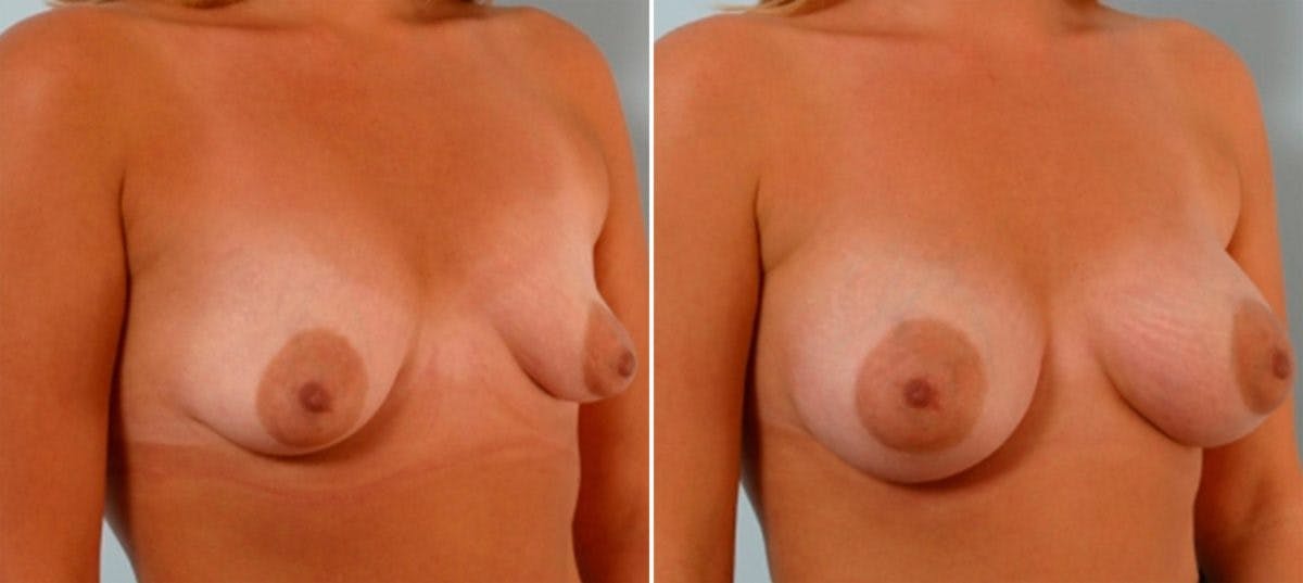 Breast Augmentation Before & After Gallery - Patient 54886834 - Image 2