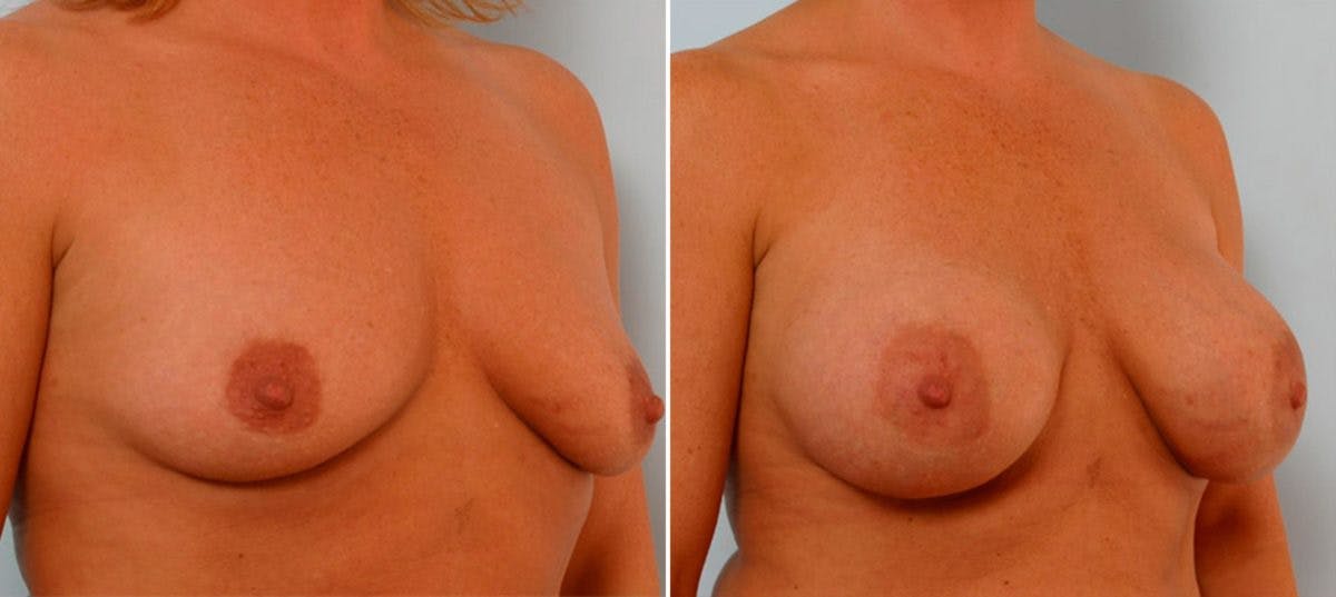 Breast Augmentation Before & After Gallery - Patient 54886838 - Image 2