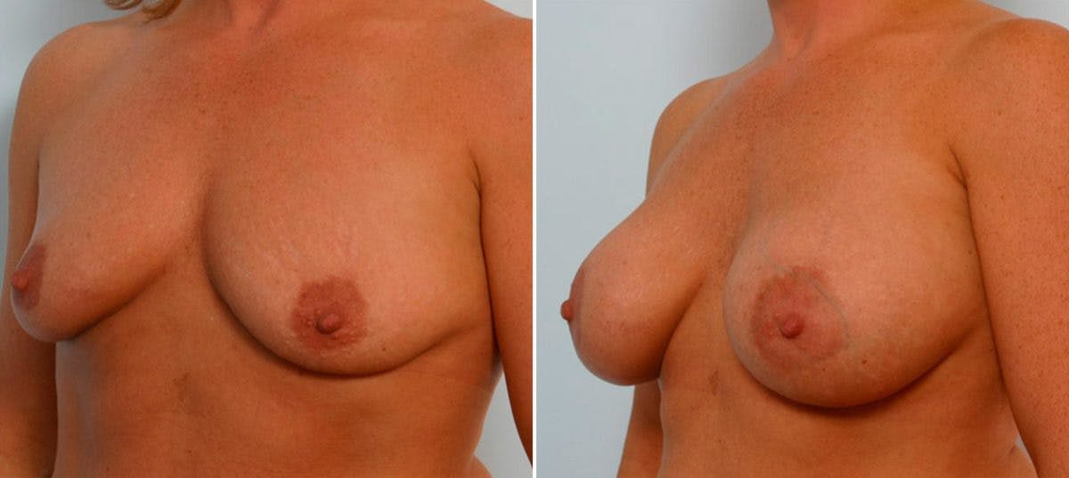 Breast Augmentation Before & After Gallery - Patient 54886838 - Image 4