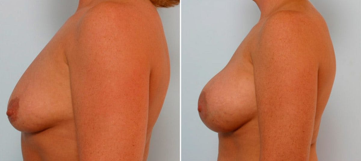 Breast Augmentation Before & After Gallery - Patient 54886838 - Image 5