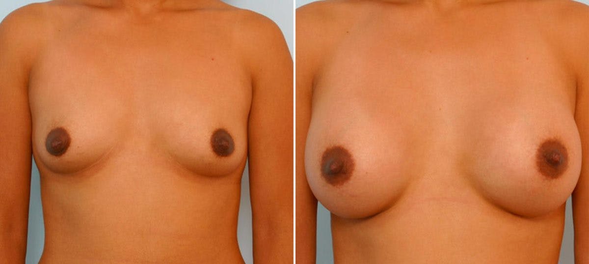Breast Augmentation Before & After Gallery - Patient 54886839 - Image 1