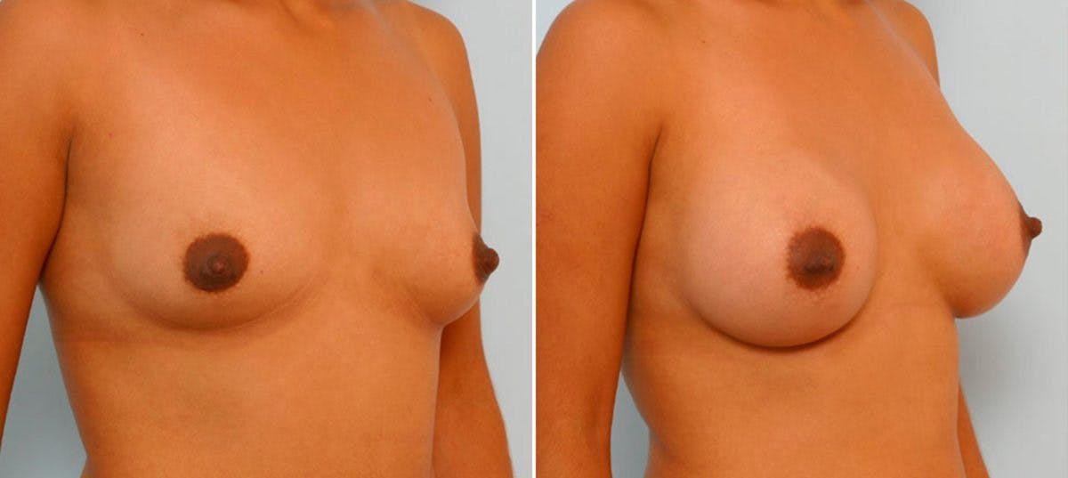 Breast Augmentation Before & After Gallery - Patient 54886839 - Image 2