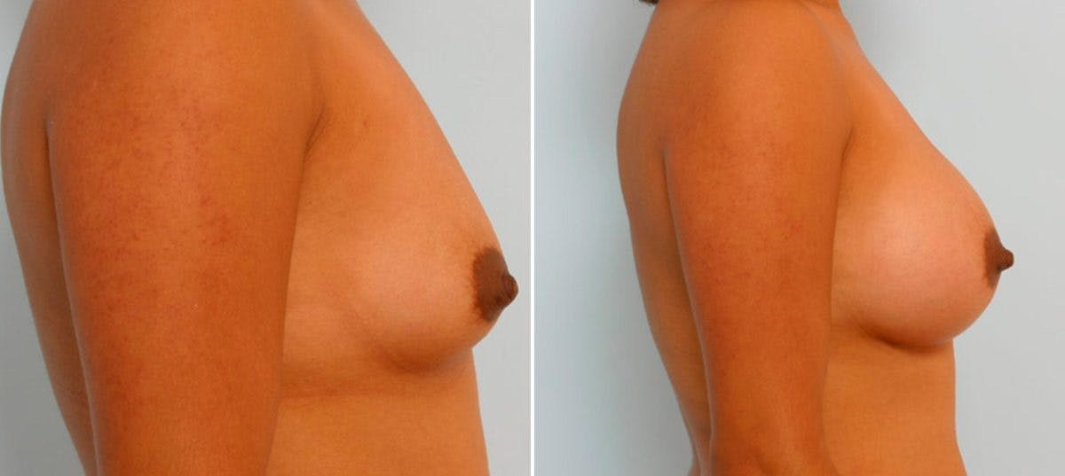 Breast Augmentation Before & After Gallery - Patient 54886839 - Image 3