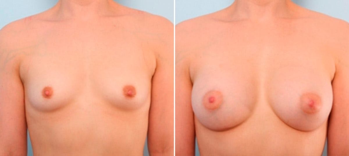 Breast Augmentation Before & After Gallery - Patient 54886841 - Image 1