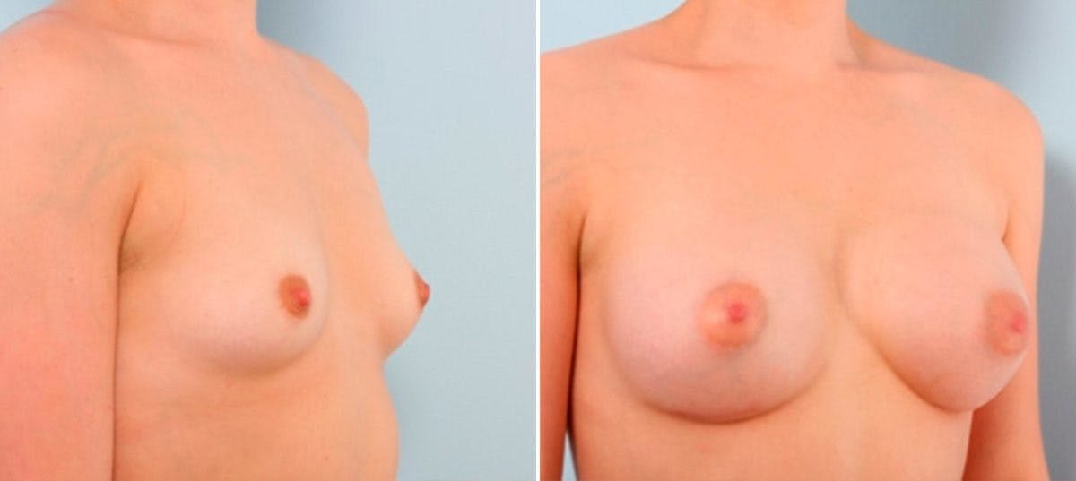 Breast Augmentation Before & After Gallery - Patient 54886841 - Image 2