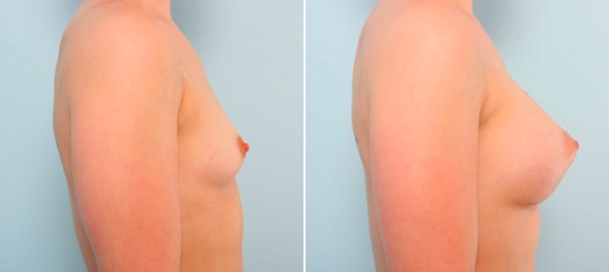 Breast Augmentation Before & After Gallery - Patient 54886841 - Image 3