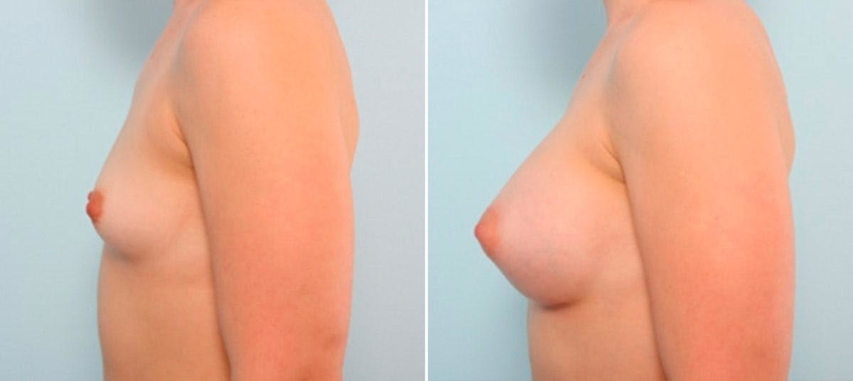 Breast Augmentation Before & After Gallery - Patient 54886841 - Image 5