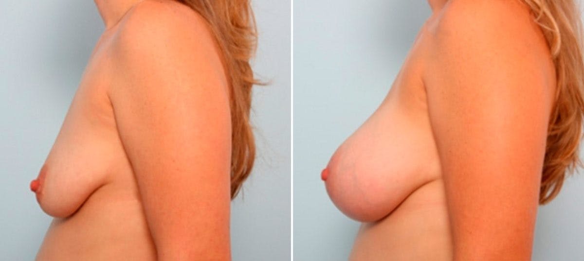 Breast Augmentation Before & After Gallery - Patient 54886842 - Image 5