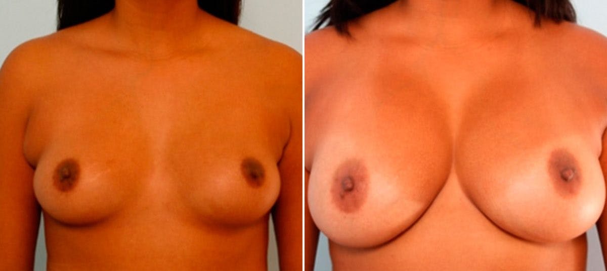 Breast Augmentation Before & After Photo - Patient 54886910 - Image 1