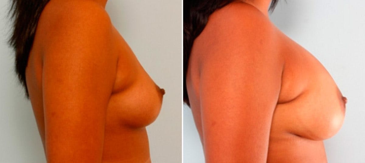 Breast Augmentation Before & After Photo - Patient 54886910 - Image 3