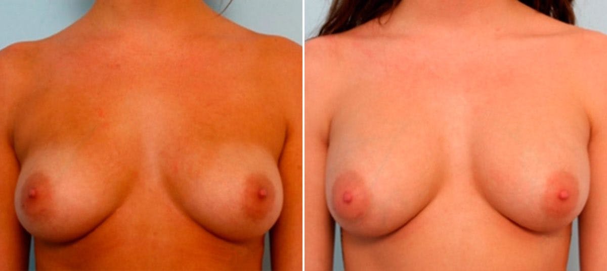 Breast Augmentation Before & After Gallery - Patient 54886915 - Image 1