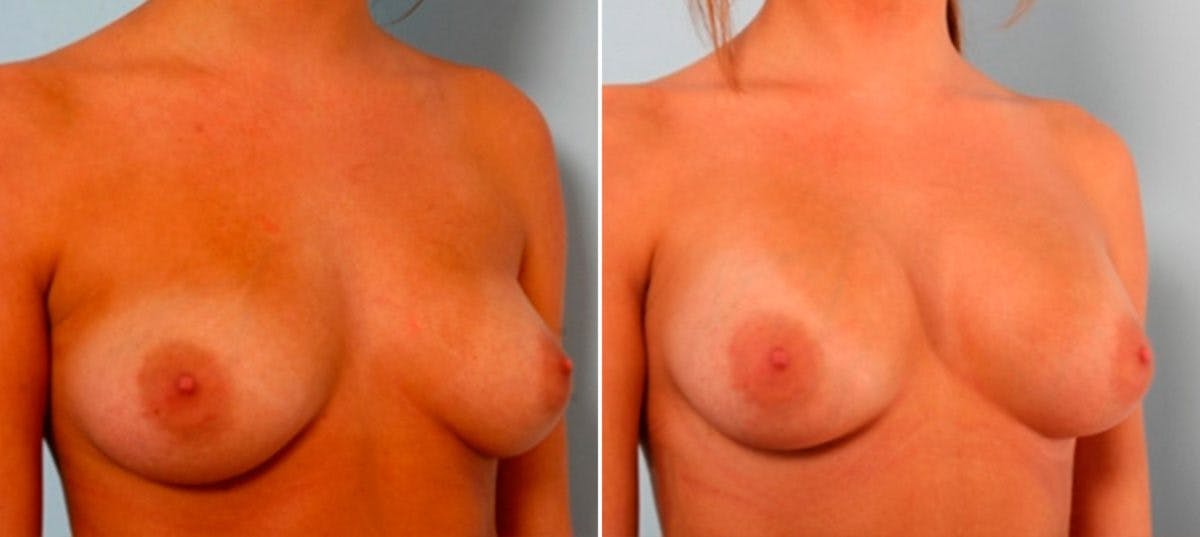 Breast Augmentation Before & After Gallery - Patient 54886915 - Image 2