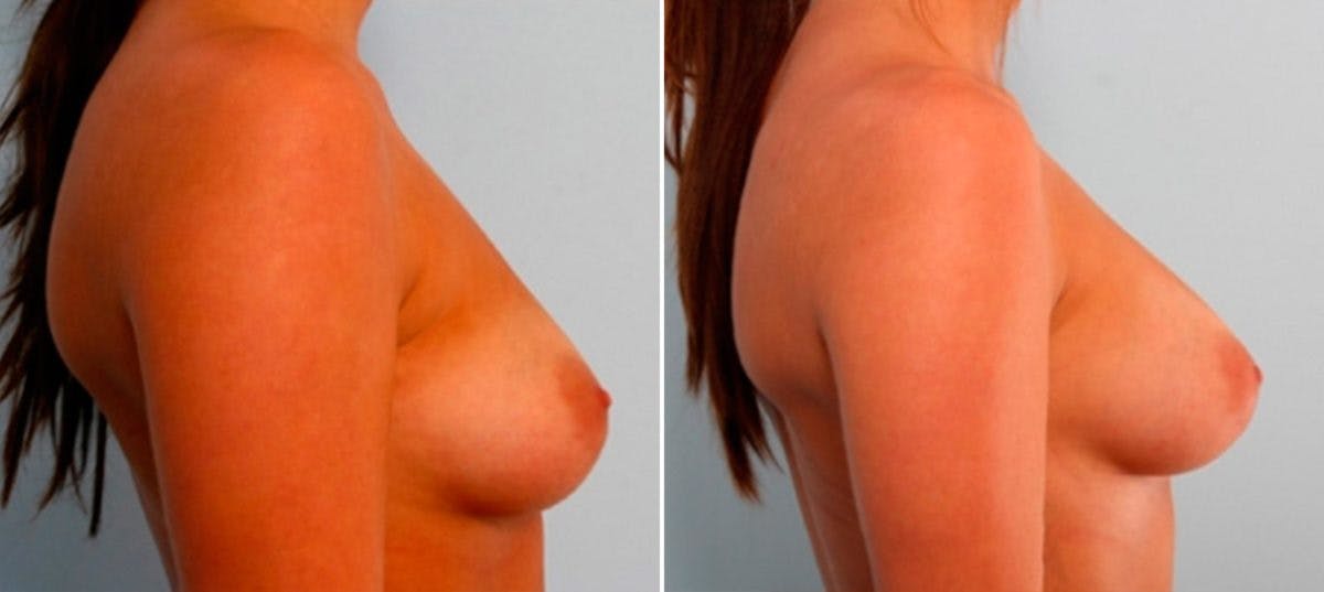 Breast Augmentation Before & After Photo - Patient 54886915 - Image 3