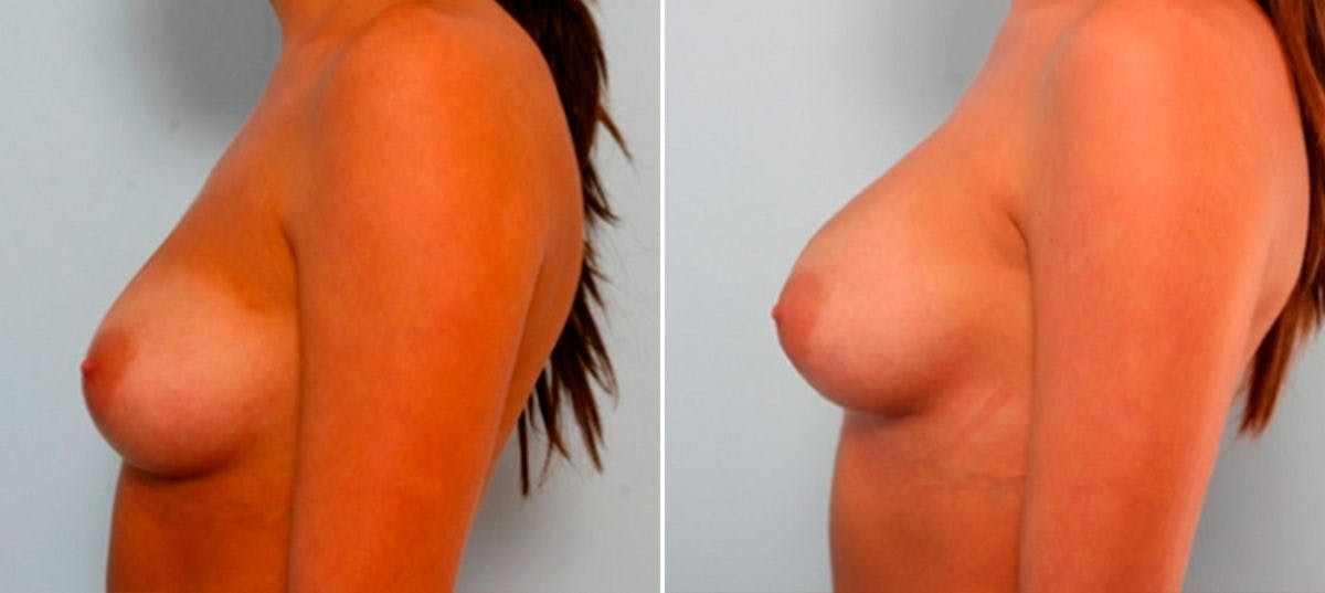 Breast Augmentation Before & After Photo - Patient 54886915 - Image 5