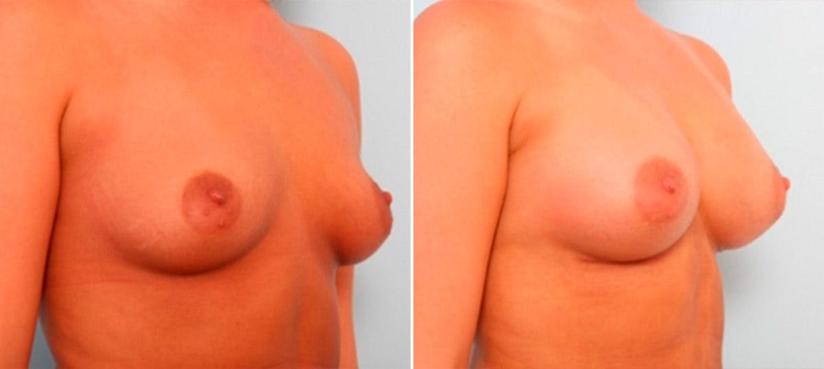 Breast Augmentation Before & After Gallery - Patient 54886916 - Image 2