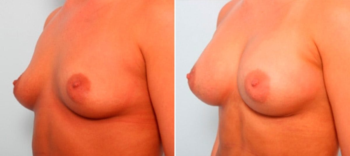 Breast Augmentation Before & After Gallery - Patient 54886916 - Image 4